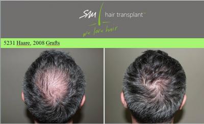 SM Hair Transplant Klinika - FUE Safe System hajbeültetés, magyar pácienseknek nagy kedvezménnyel!